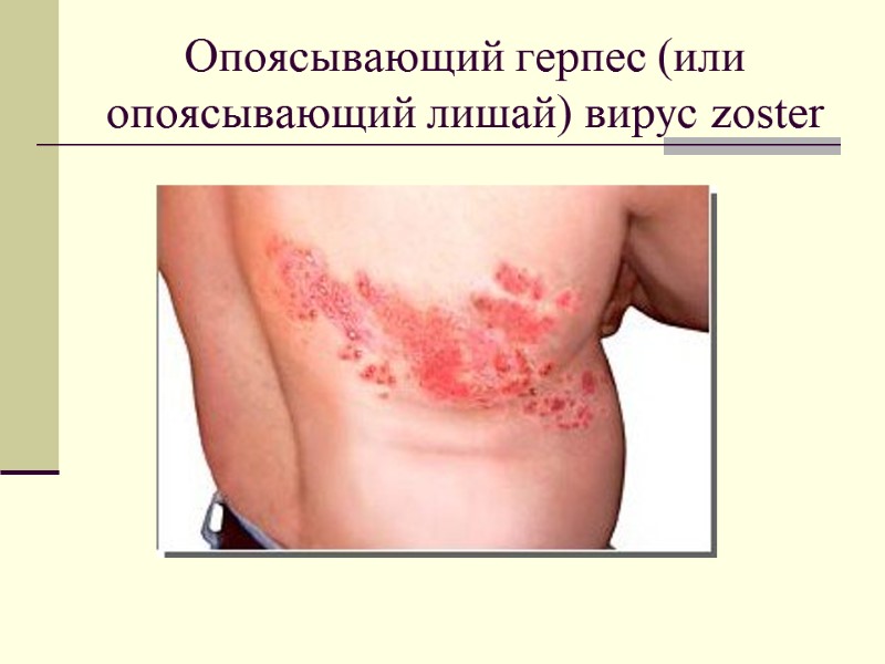 Опоясывающий герпес (или опоясывающий лишай) вирус zoster